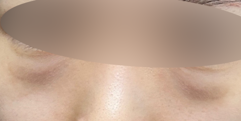 눈밑지방재배치 후기