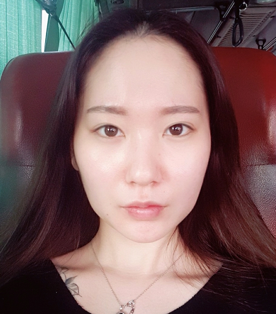 사각턱수술 후기