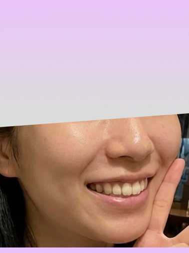 온다리프팅 후기