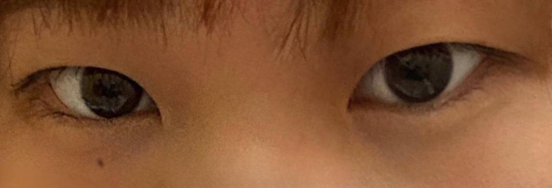 밑트임 후기