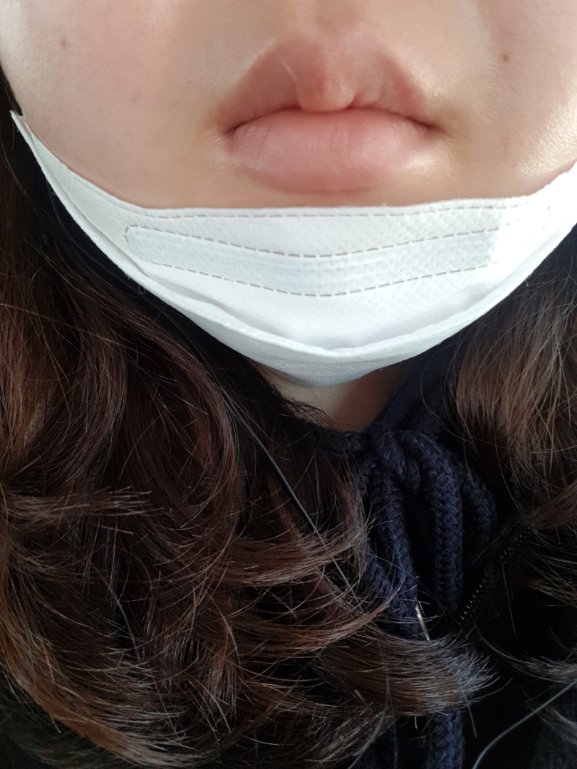 입꼬리성형 후기
