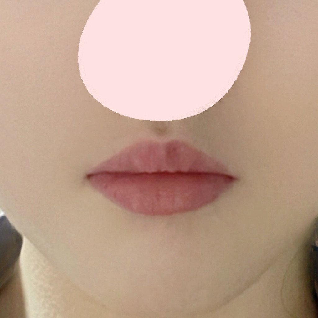 입꼬리성형 후기