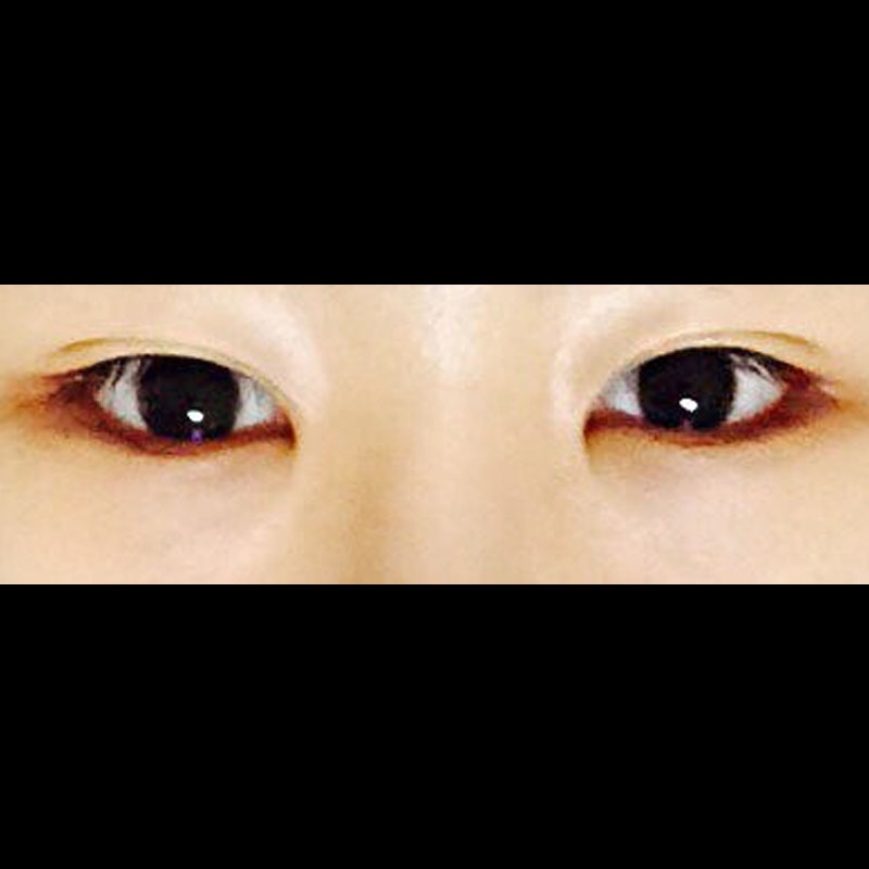 밑트임 후기