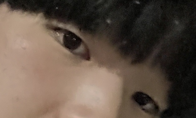 눈매교정 후기