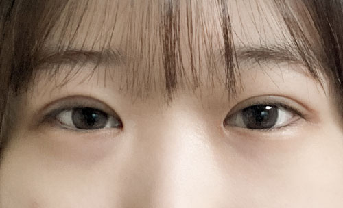 눈재수술 후기