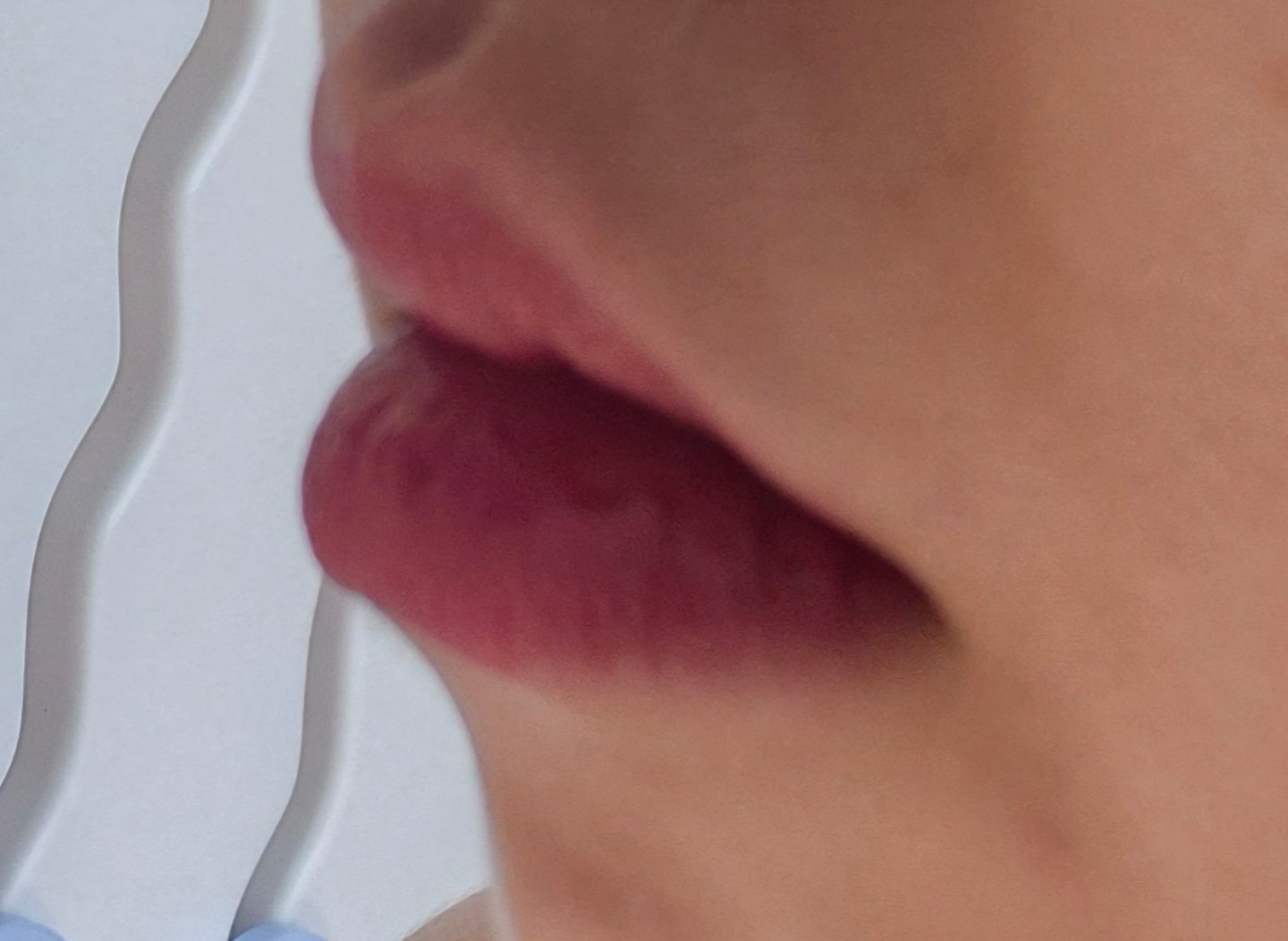 입꼬리성형 후기