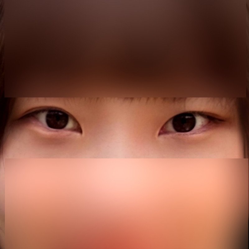 눈재수술 후기