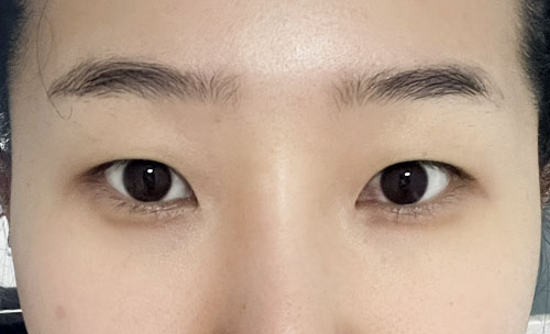 쌍꺼풀(자연유착) 후기