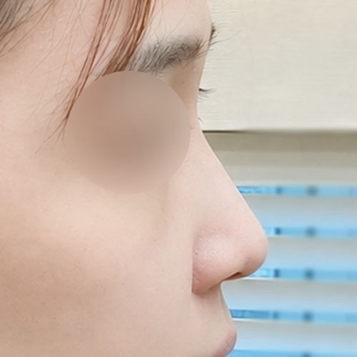 콧대(보형물) 후기
