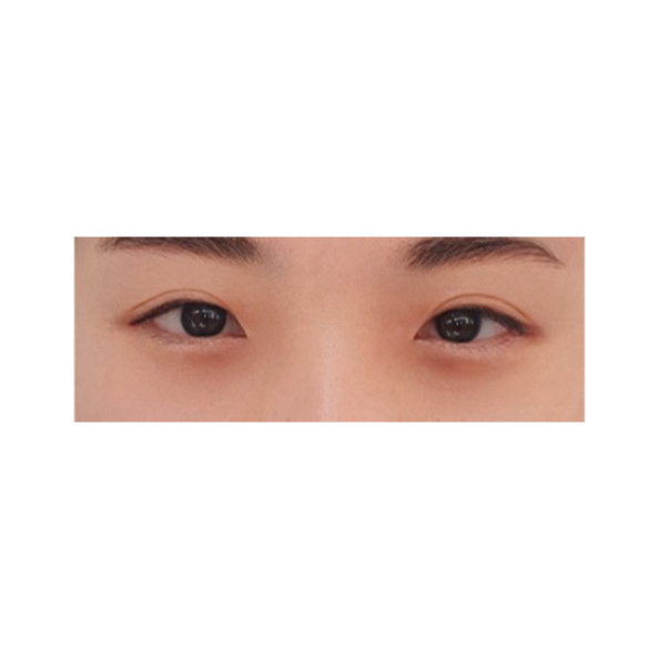 눈재수술 후기