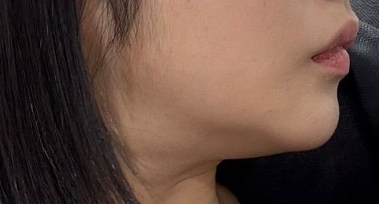 턱끝보톡스 후기