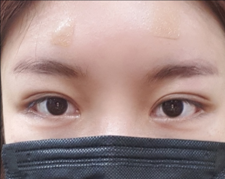 앞트임 후기