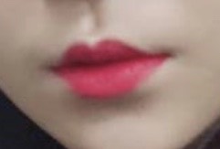 인중축소술 후기