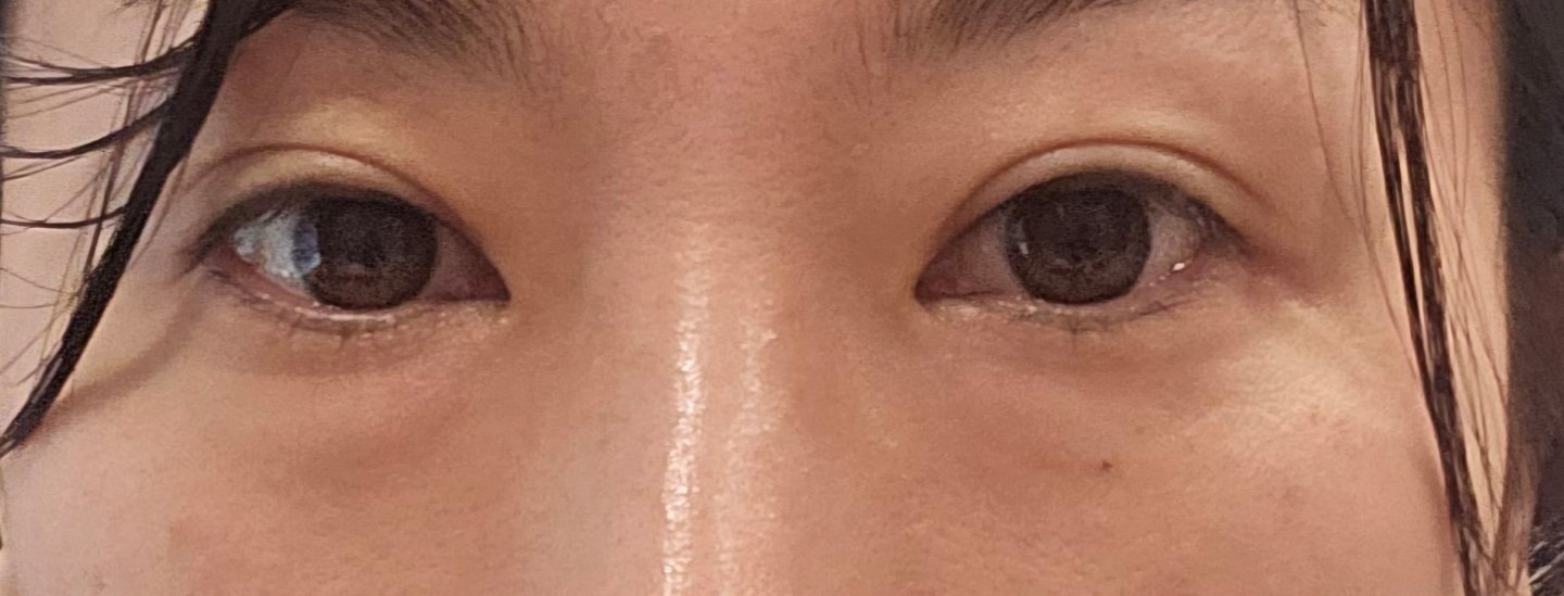하안검성형 후기