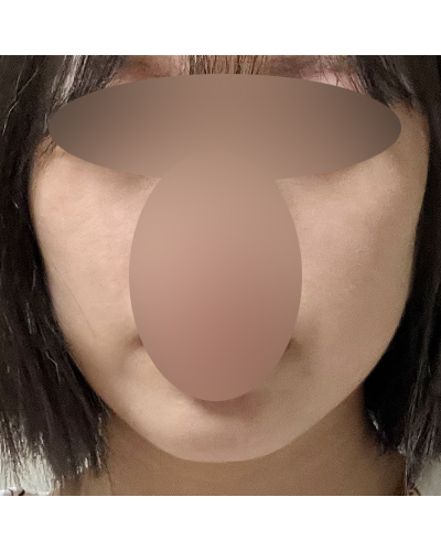 실리프팅 후기