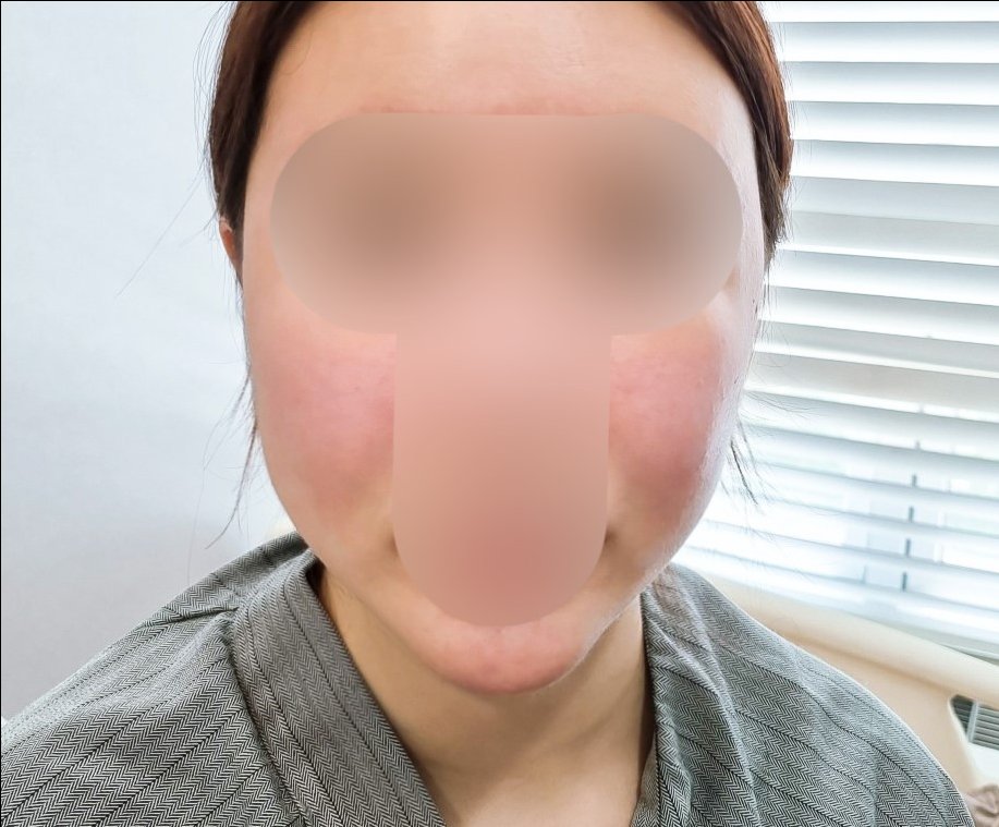 실리프팅 후기