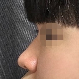 코끝(기증연골) 후기