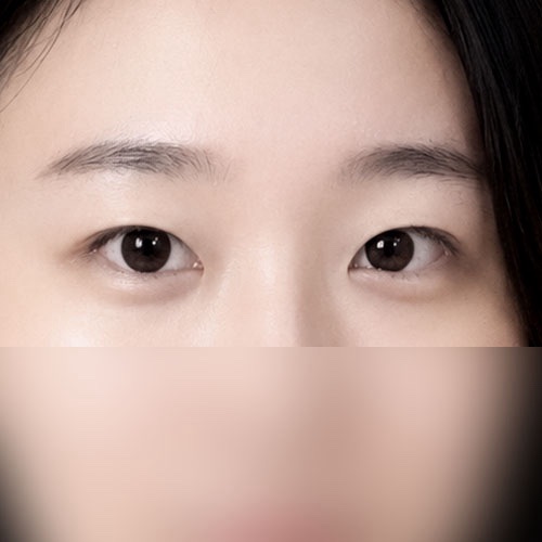 눈재수술 후기