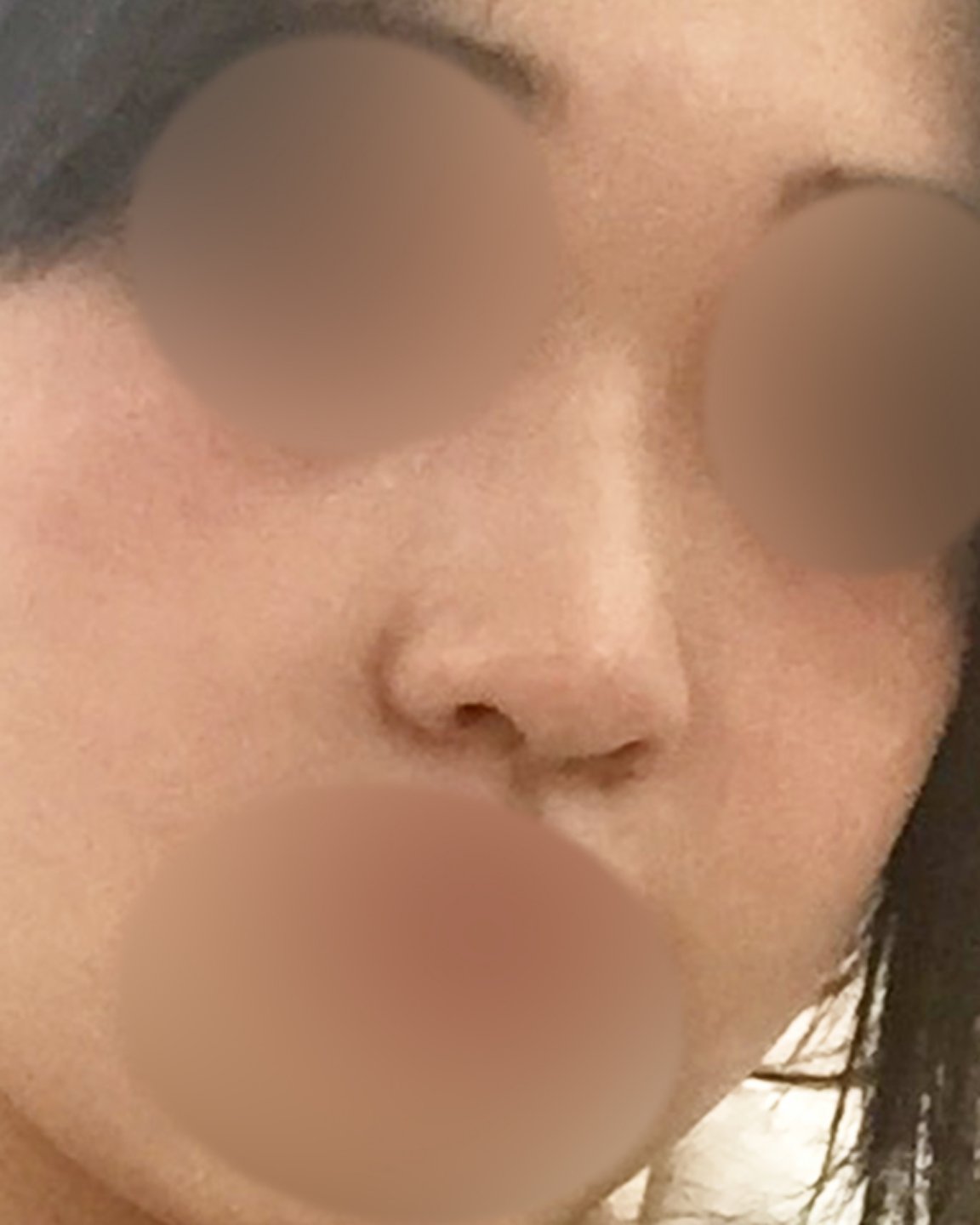 콧대(보형물) 후기