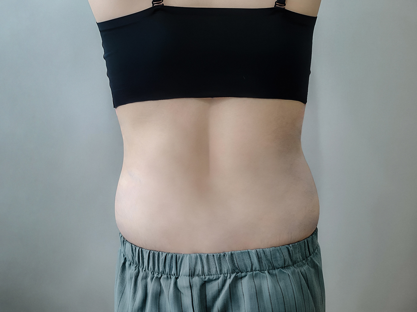 러브핸들지방흡입 후기