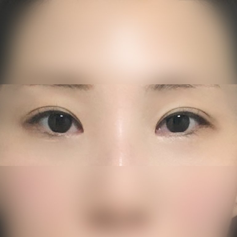밑트임 후기