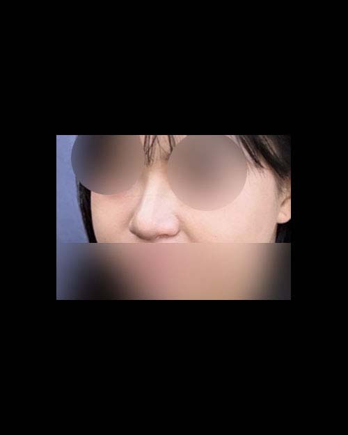 코재수술 후기