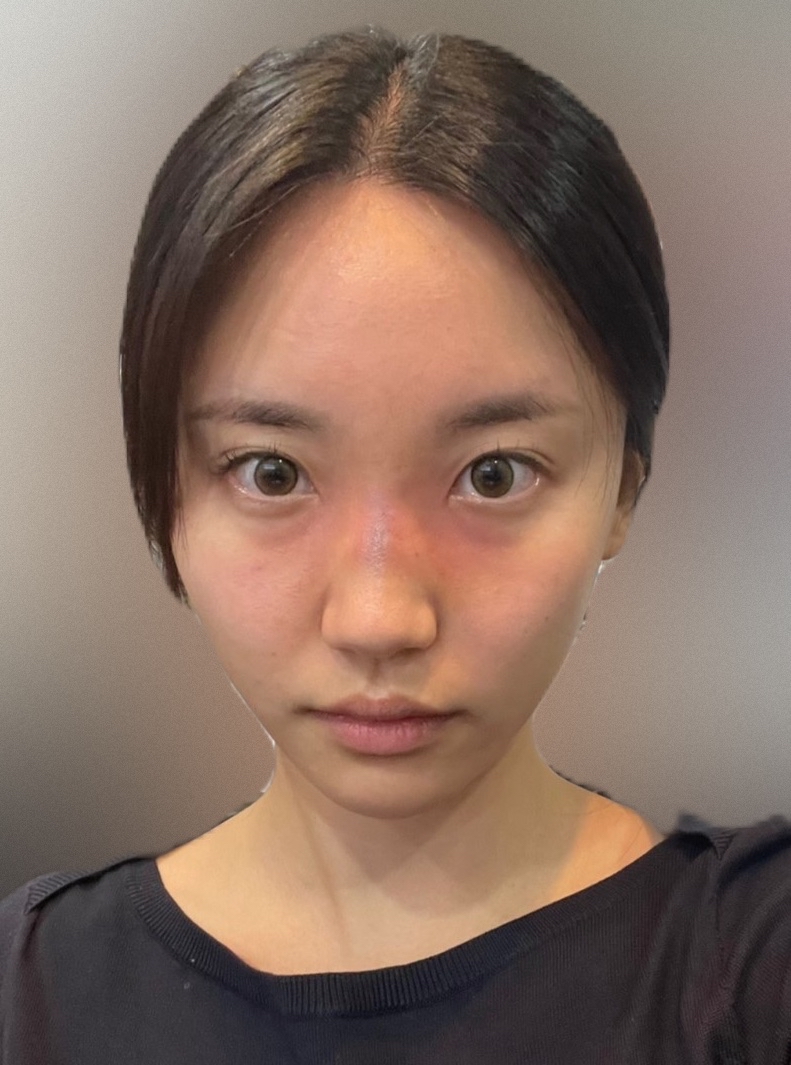 콧대(보형물) 후기