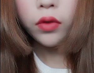 입꼬리성형 후기