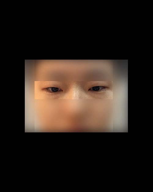 쌍꺼풀(자연유착) 후기