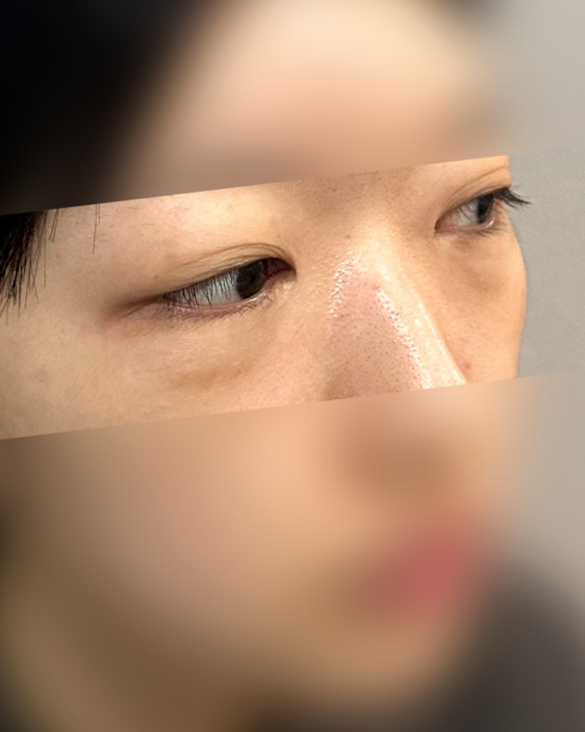눈밑지방재배치 후기