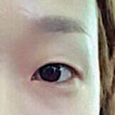 쌍꺼풀(절개) 후기