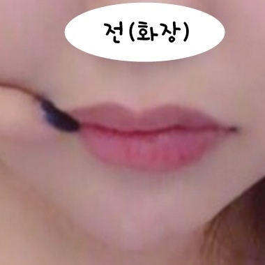 입꼬리성형 후기