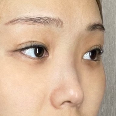 쌍꺼풀(절개) 후기
