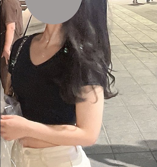 팔지방흡입 후기