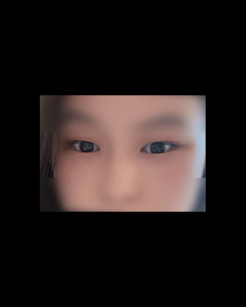 눈재수술 후기