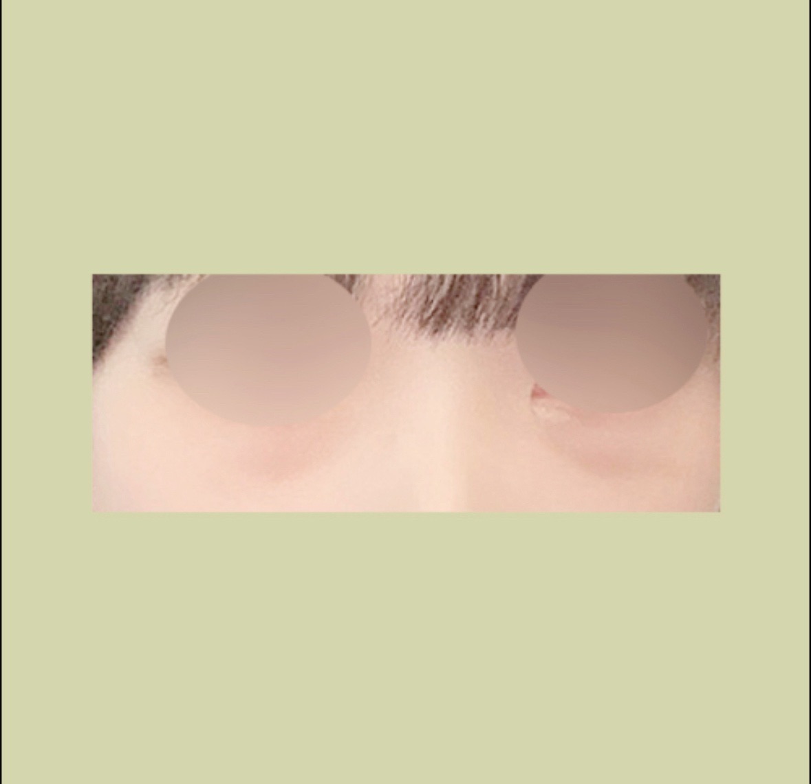 눈밑지방재배치 후기