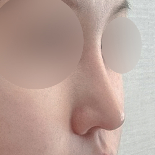 코재수술 후기