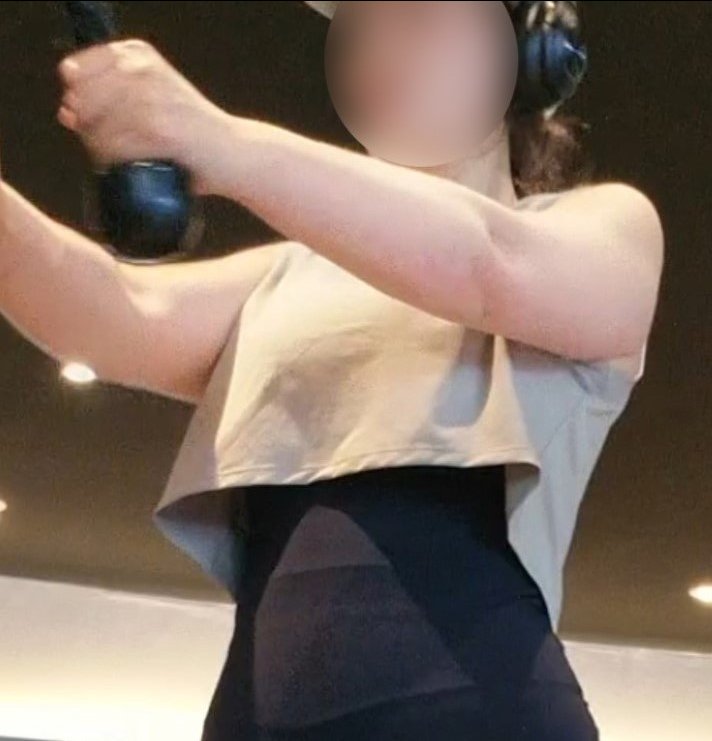 팔지방분해주사 후기
