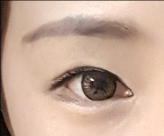 눈재수술 후기