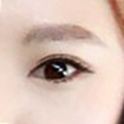 눈재수술 후기