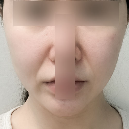 실리프팅 후기