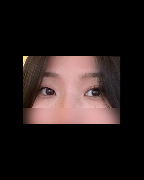 눈재수술 후기