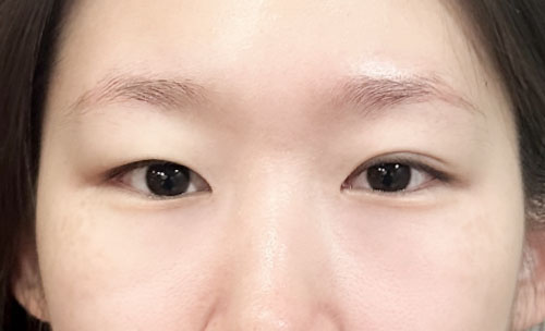 쌍꺼풀(자연유착) 후기