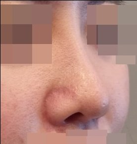 콧볼축소 후기