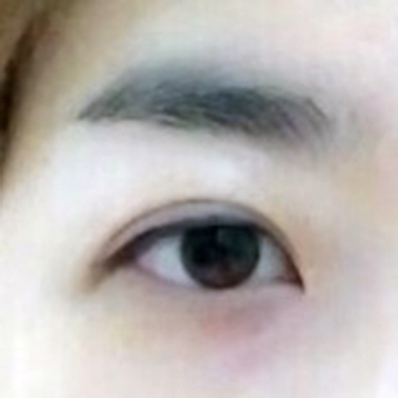 눈재수술 후기