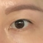 눈재수술 후기