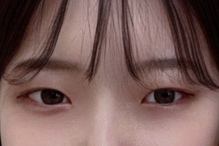 눈재수술 후기