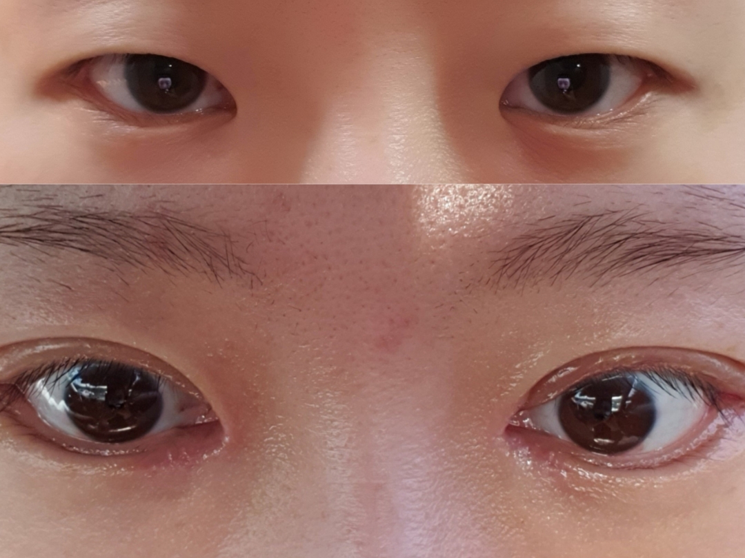 쌍꺼풀(절개) 후기