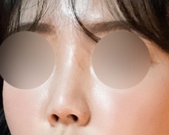 콧대(인공조직) 후기