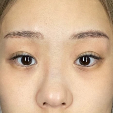 눈재수술 후기